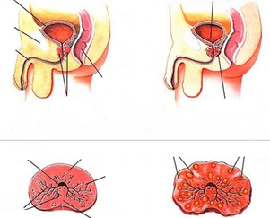 normal prostate and chronic prostatitis