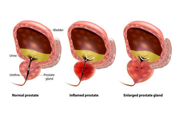 Prostatitis is an inflammation of the prostate gland