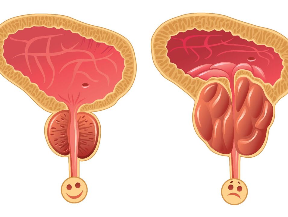 Prostate obstruction with healthy prostate gland and congestive prostatitis