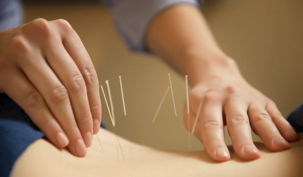 Acupuncture is a common method of treating chronic prostatitis