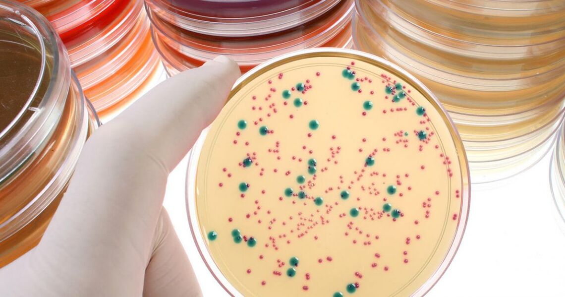 Bacterial chronic prostatitis is detected by analyzing urine and prostate secretions