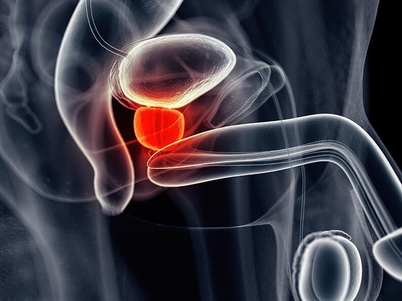 Inflammation of the prostate gland accompanied by chronic prostatitis
