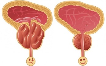 how Prosteri prostatitis before and after treatment